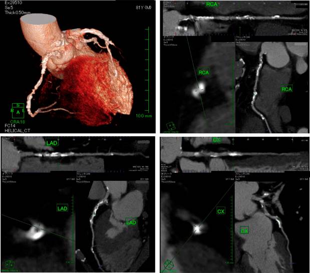 Relation Between Erectile Dysfunction and Silent Myocardial Ischemia in Diabetic Patients: A Multidetector Computed Tomographic Coronary Angiographic Study.