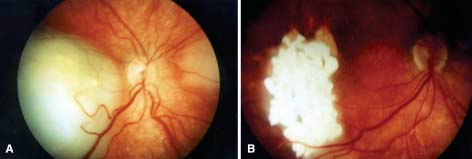 Recent Decreasing Frequency of Enucleation for Intraocular Retinoblastoma in Upper Egypt