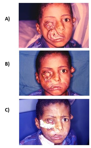 Management of Rare Craniofacial Anomalies With Soft Tissue Reconstruction on Charity Medical Missions