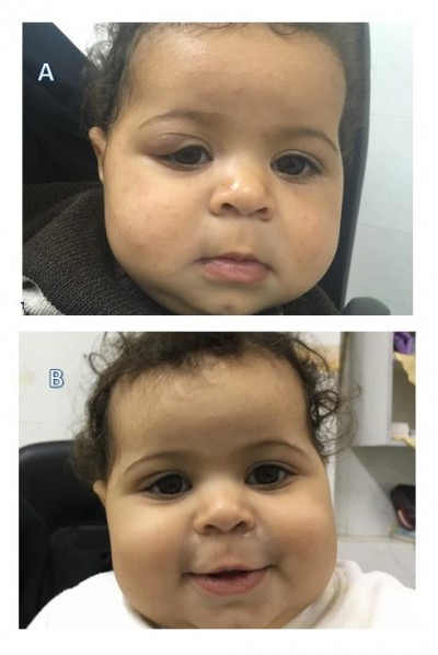 Combined oral propranolol with intralesional injection of triamcinolone acetonide in treatment of infantile periocular hemangiomas