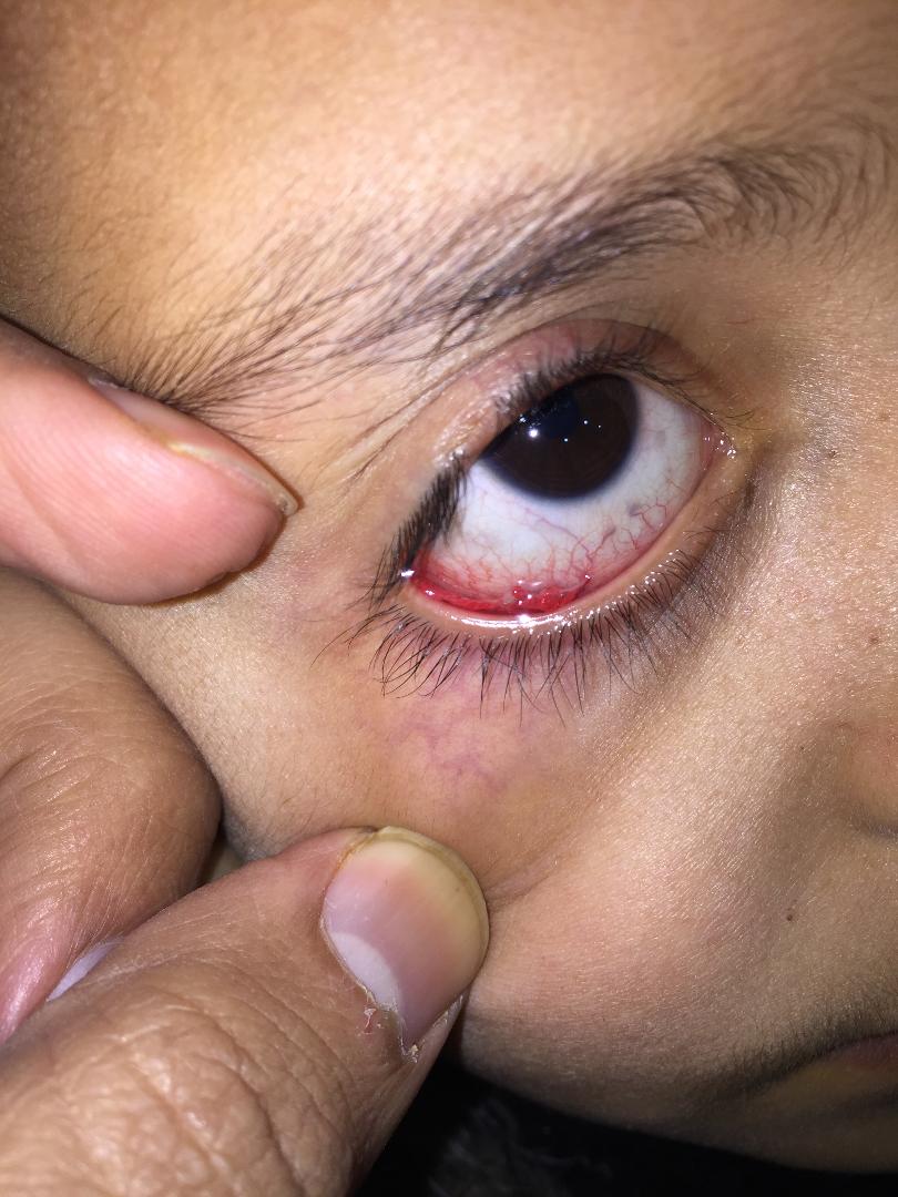 Pediatric self-inflicted eye trauma due to a major depressive disorder