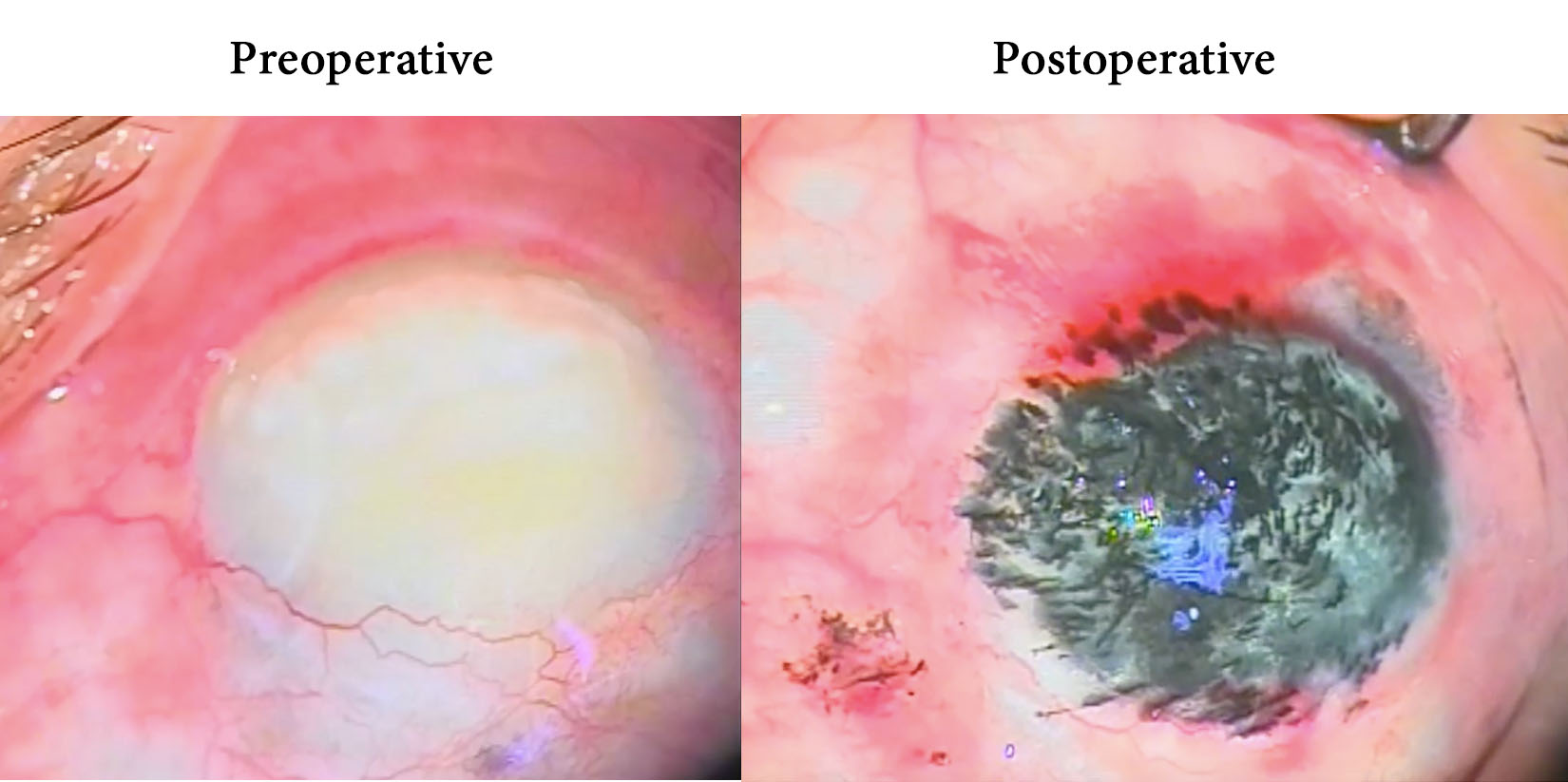 Outcomes of Corneal Tattooing by Rotring Painting Ink in Disfiguring Corneal Opacities