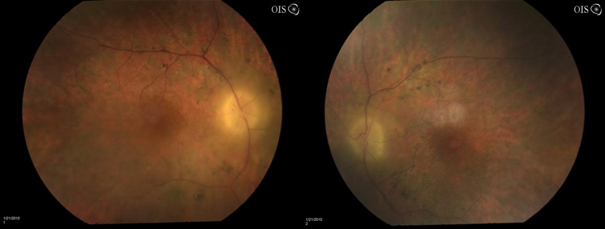 Retinitis pigmentosa associated with Idiopathic Panuveitis: Two cases reports