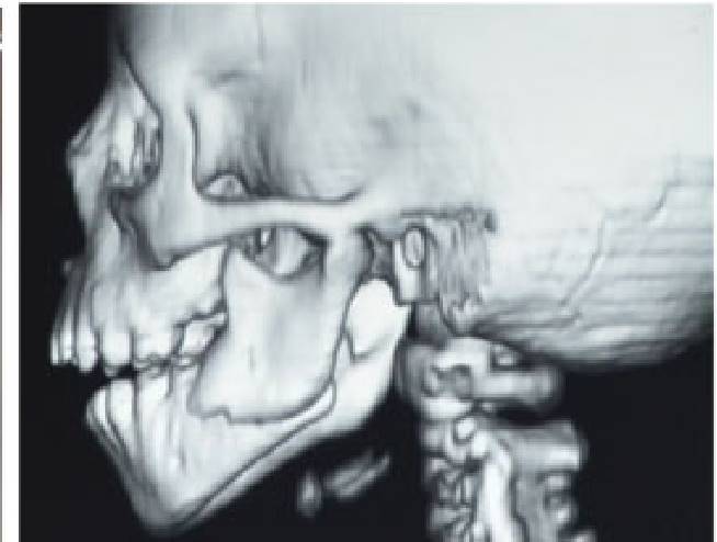 Early Experience with Biodegradable Fixation of Pediatric Mandibular Fractures