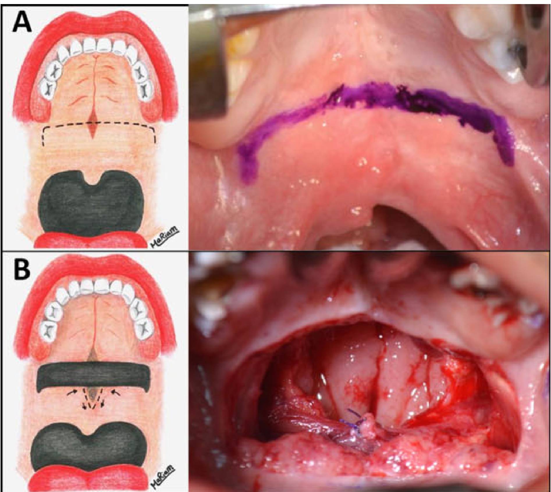Buccinator Re-Repair (Bs + Re: IVVP): A Combined Procedure to Maximize the Palate Form and Function in Difficult VPI Cases.
