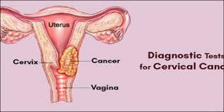 seminar on cancer cervix