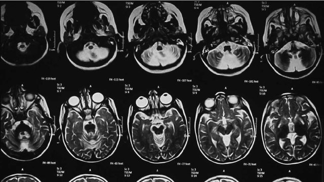 The role of brain MRI and MRspectoscopy I'm the diagnosis of demylinating brain disease among Egyptian Children