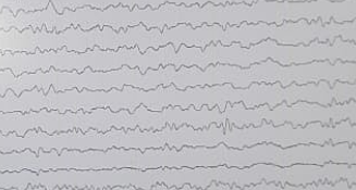 Is this EEG normal or abnormal