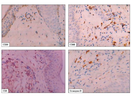 Immunohistochemical analysis of the immune cells in  the epithelioid cell granuloma of tuberculoid leprosy