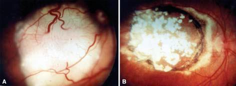 The role of chemoreduction Among Recent Treatment Modalities for Intraocular retinoblastoma