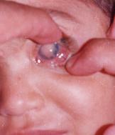 Fine-needle aspiration biopsy for retinoblastoma: Is it safe or hazardous?
