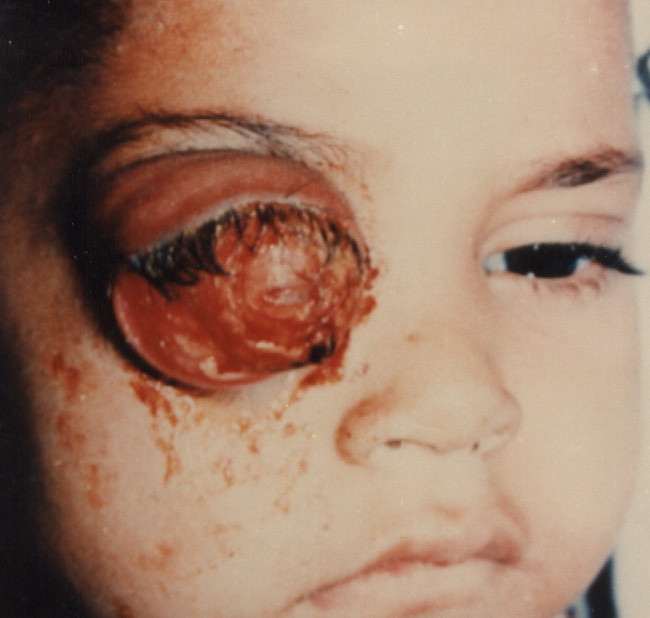 Extraocular Retinoblastoma: How to Avoid and How to Manage?