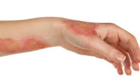 Nutritional Status and Wound Healing among Patients with Burn Injury: A Correlational Study