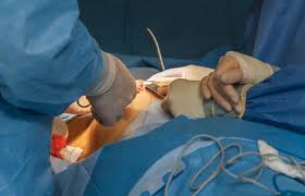 Effect Of Nursing Care Bundle on the Outcomes of Women Undergoing Breast Surgeries