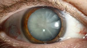 Assessment of the Cataract Patients’ Knowledge about Indicators of Intraocular Lenses Dislocation and Malposition