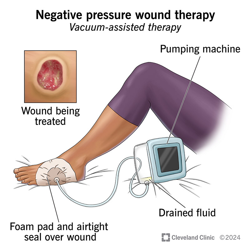 Assessment of Nurses' Readiness for Care of Patients Who Undertake Negative Pressure Wound Therapy