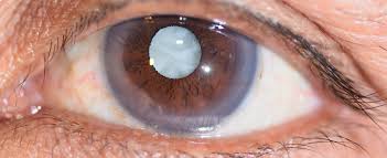 Assessment of the Cataract Patients’ Knowledge about Indicators of Intraocular Lenses Dislocation and Malposition