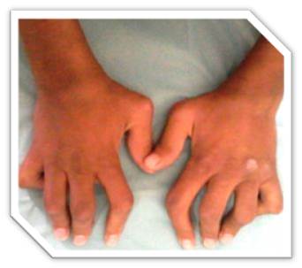 A worldwide rare syndrome, relatively frequent in Upper Egypt