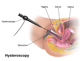 TRANSCERVICAL INTRAPERITONEAL ANALGESIA AFTER OPERATIVE GYNECOLOGICAL LAPAROSCOPY: IS IT AN EFFECTIVE?