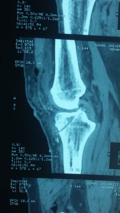 Comparative study between interference screw fixation and implant free technique in anterior cruciate ligament reconstruction using semitendinosus and gracilis auto graft