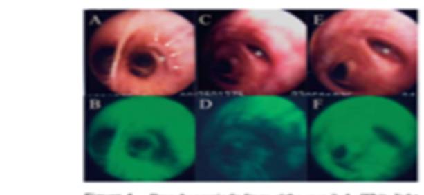 Follow-up using fluorescence bronchoscopy for the patients with photodynamic therapy treated early  lung cancer