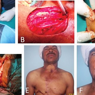 Publication Preview Source Reliability of Pectoralis Major Myocutaneous Flap in Reconstruction of Cervicofacial Defects Following Ablative Oncological Surgery