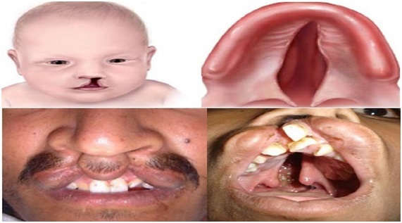 Cleft Lip and Palate: An Experience of a Developing Center in Egypt