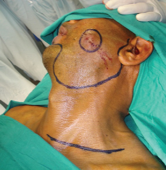 Reliability of Pectoralis Major Myocutaneous Flap in Reconstruction of Cervicofacial Defects Following Ablative Oncological Surgery