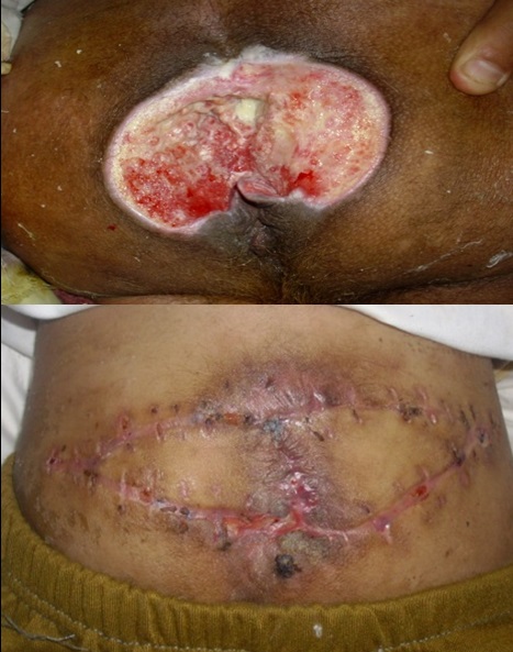 Modalities of Surgical Management of Pressure Sores in Sohag University Hospital: A review of 42 cases
