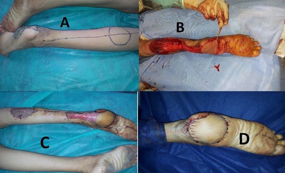 Different Modalities Used for Reconstruction of Soft Tissue Defects of the Foot in Sohag University Hospital