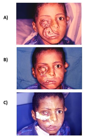 Management of Rare Craniofacial Anomalies in Charity Missions: Community-Based Solutions