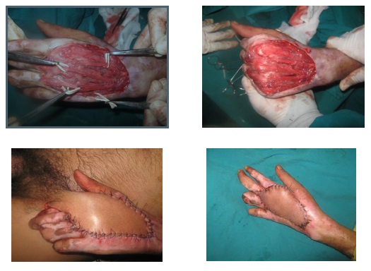 Soft Tissue Reconstruction of Hand Trauma: A 1-year Retrospective Study of 745 Cases.