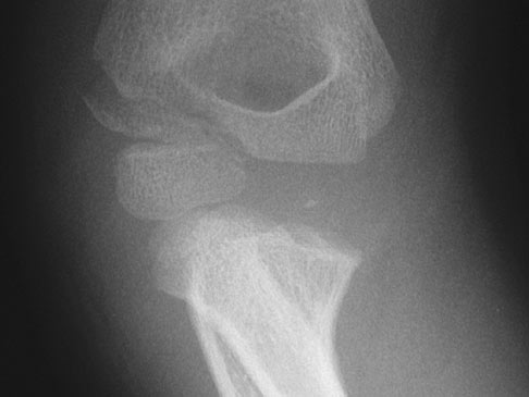 Lateral Condyle Fracture - Pediatric