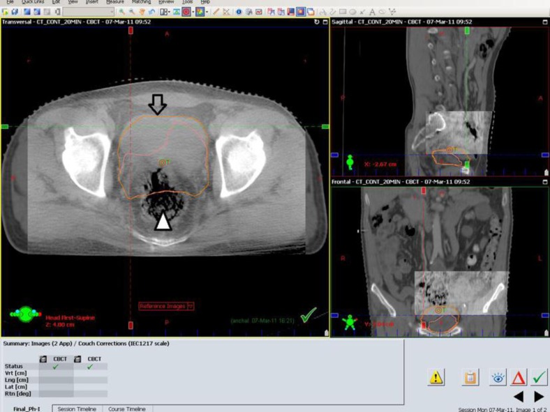 Answer the following question: describe the details of radiation therapy for bladder cancer