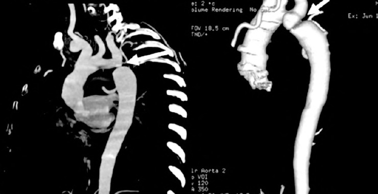 Aortic Coarctation: Evaluation with Computed Tomography Angiography in Pediatric Patients