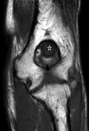 Stiff elbow in adult: MR imaging findings