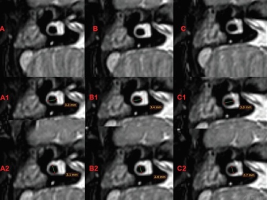 Value of magnetic resonance imaging measurement of lateral semicircular canal bone island in sensorineural hearing loss patients