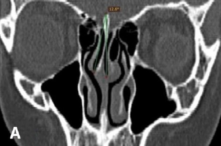 Coincidence of Concha Bullosa with Nasal Septal Deviation; Radiological Study