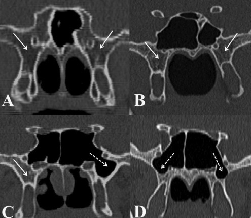 CT evaluation of pterygoid process pneumatization and the anatomic variations of related neural structures