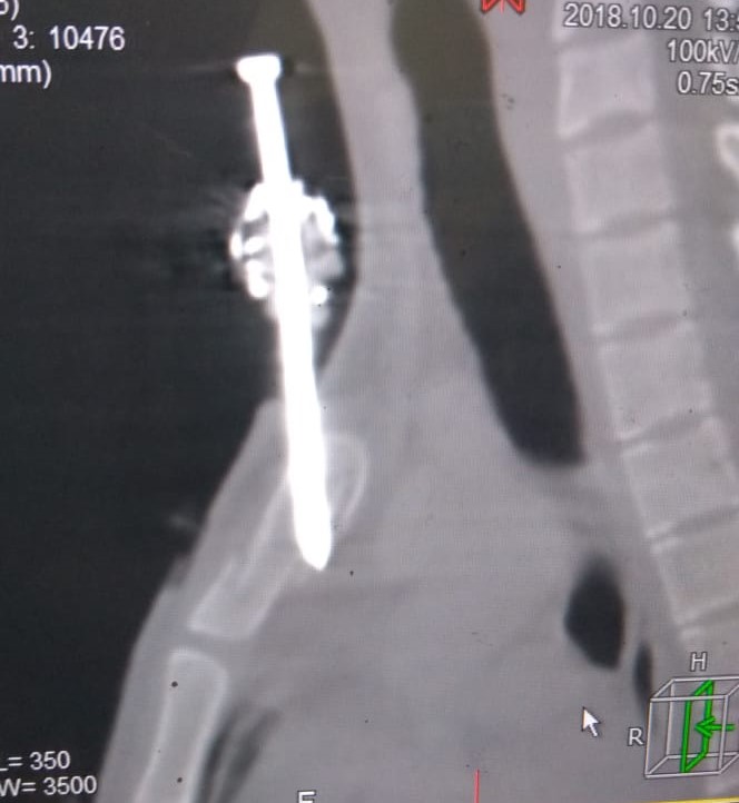 Nail Gun Impacted in the Chest Wall: Report of a Failed Trail of Home Extraction by Patient’s Relatives