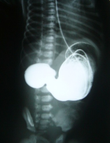 Imaging of Neonatal Upper Gastro-Intestinal Atresia Beyond the Esophagus in Correlation with Surgical Findings