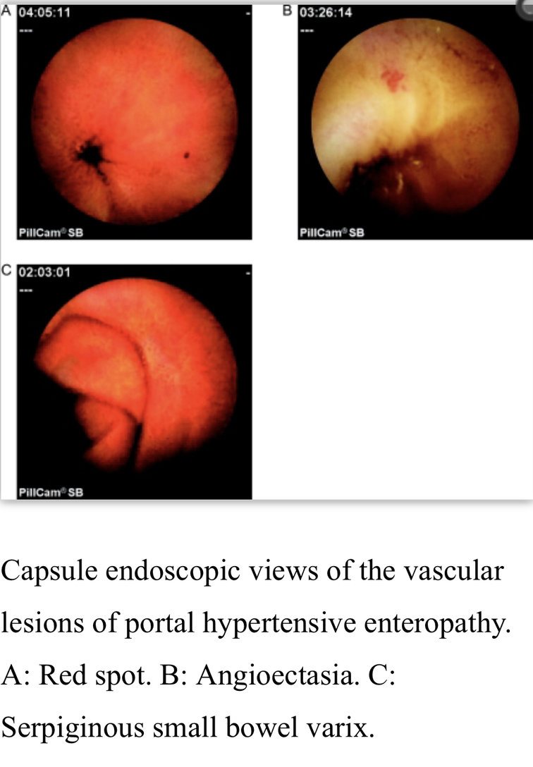 Evaluation of Portal Hypertensive Enteropathy by Scoring with Capsule Endoscopy: Is Transient Elastography of Clinical Impact? )