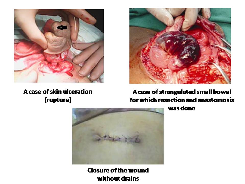 EMERGENT SURGICAL TREATMENT FOR COMPLICATED UMBILICAL HERNIA IN PATIENTS WITH CHRONIC LIVER DISEASE