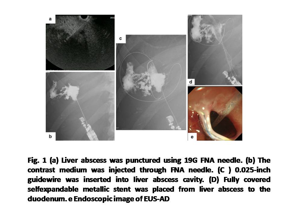 Clinical Outcome of Endoscopic Ultrasound-Guided Liver Abscess Drainage Using Self-Expandable Covered Metallic Stent (with Video).