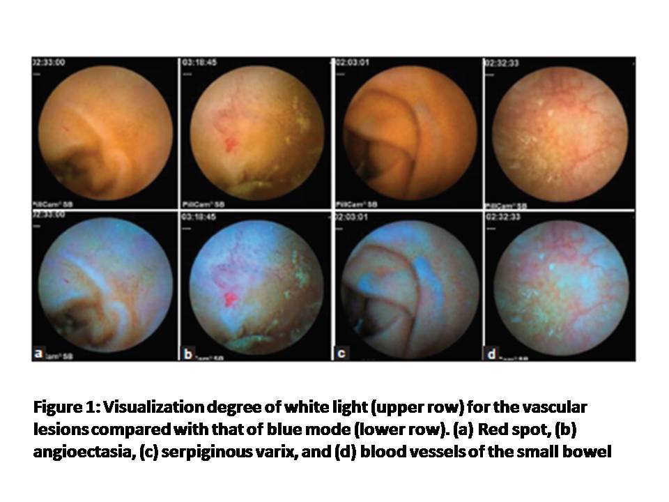 Blue Mode Imaging May Improve the Detection and Visualization of Small- Bowel Lesions: Capsule Endoscopy Study