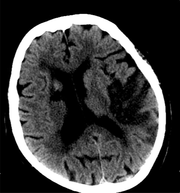 Ischemic Versus Hemorrhagic Stroke in Patients with First Ever Stroke in Sohag: Risk Factors, Presentations, and Stroke Severity